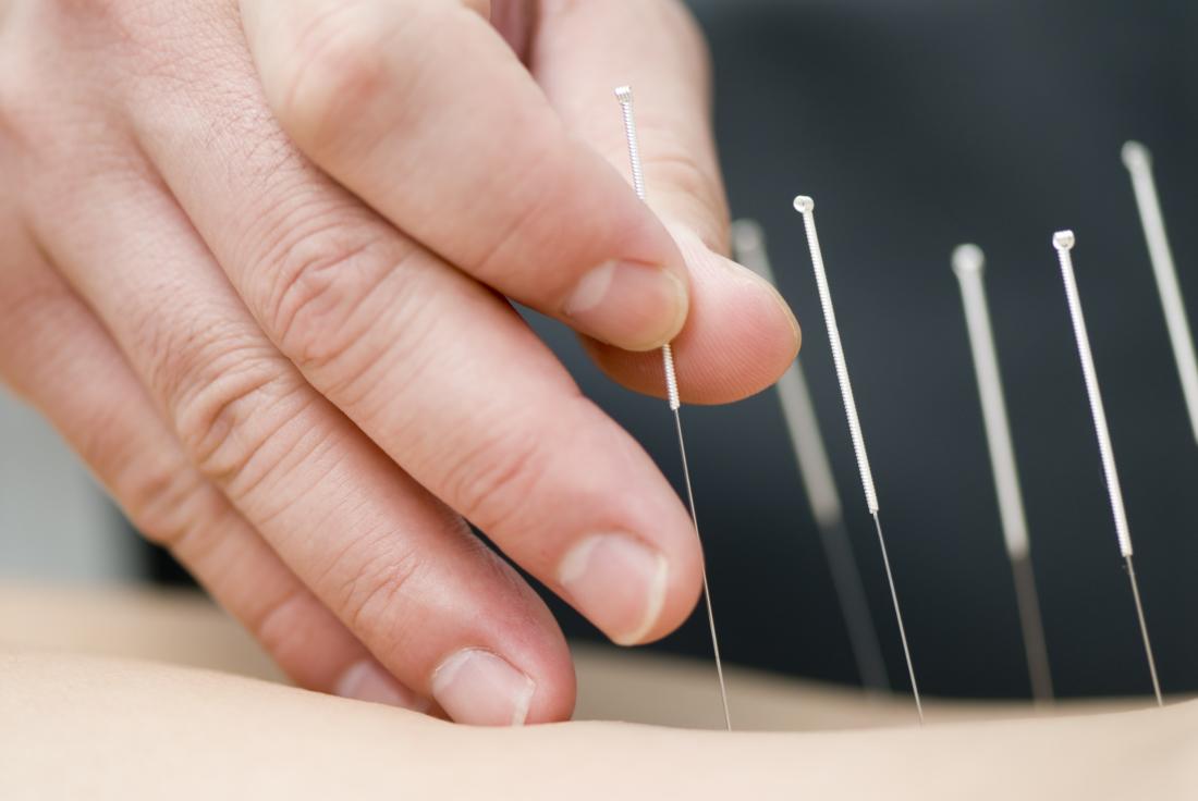 Acupuncturist applying acupuncture needles to skin