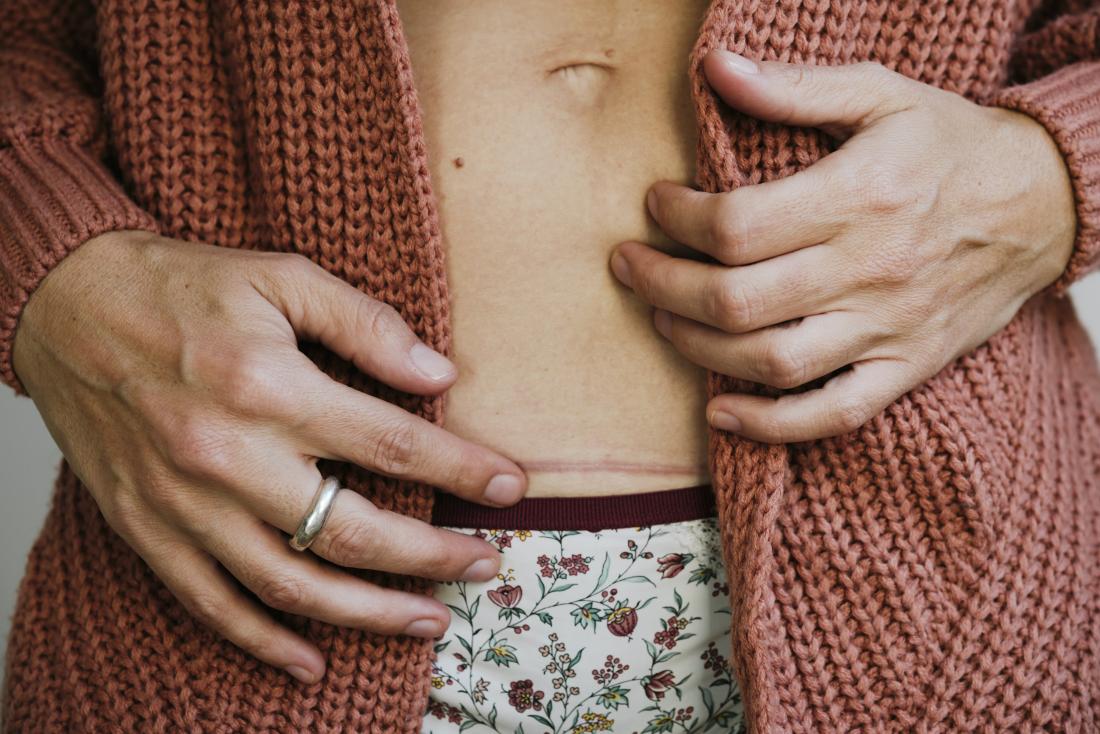 Woman with endometriosis and a cesarean scar on her belly