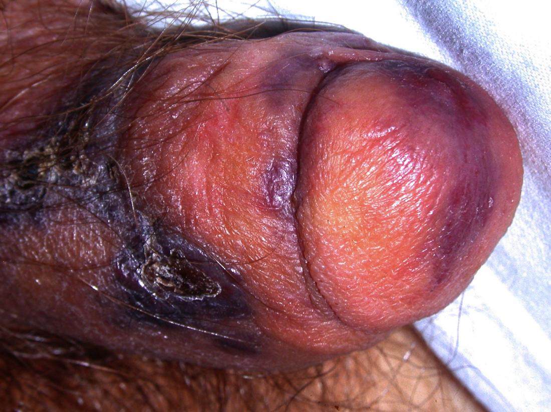 Penile cancer <br>Image credit: DermNet New Zealand</br> 