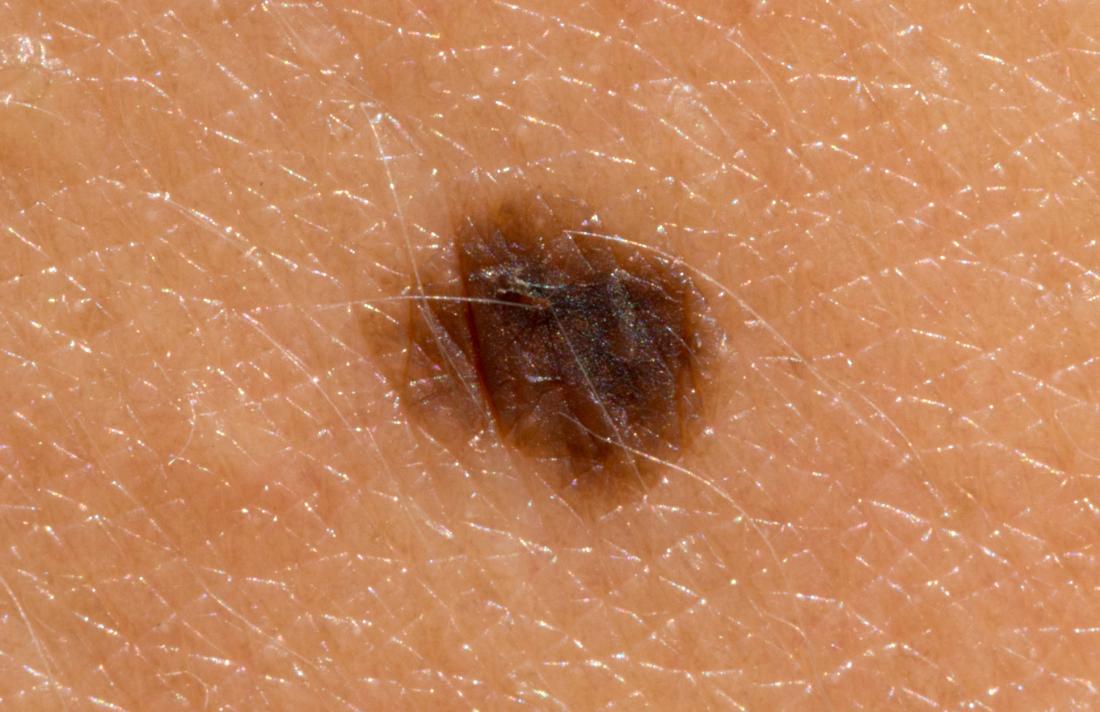 melanoma skin cancer