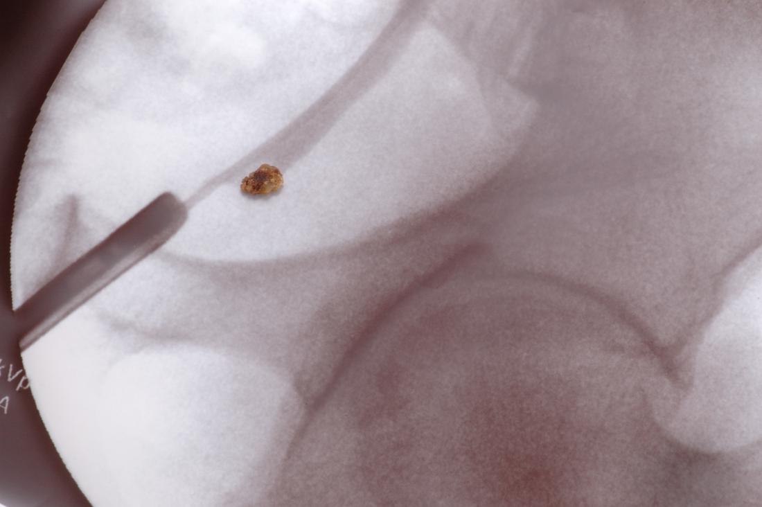 Bladder pain kidney stone